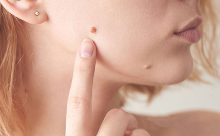 روش های از بین بردن خال گوشتی